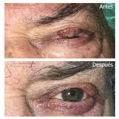Extirpación de carcinoma basocelular en párpado superior izquierdo (lámina anterior) y reconstrucción mediante colgajo de avance. Extirpación de carcinoma basocelular en párpado superior izquierdo (lámina anterior) y reconstrucción mediante colgajo de avance.