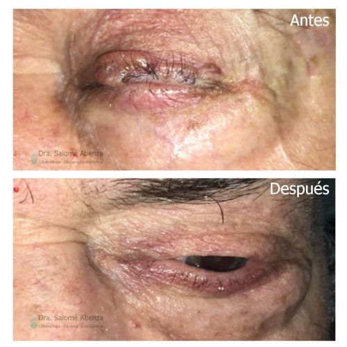 Extirpación de carcinoma basocelular en párpado superior izquierdo (lámina anterior) y reconstrucción mediante colgajo de avance. Extirpación de carcinoma basocelular en párpado superior izquierdo (lámina anterior) y reconstrucción mediante colgajo de avance.