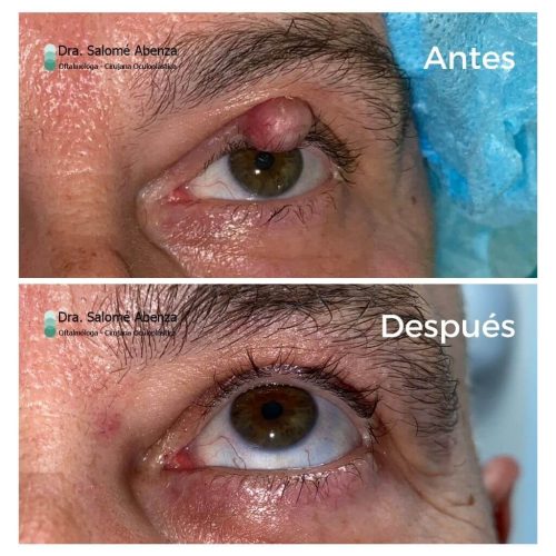 Tumor en párpado de ojo izquierdo con mirada hacia arriba antes y después de la cirugía