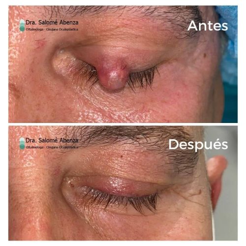 Tumor palpebral en ojo izquierdo antes y después de la cirugía con ojo cerrado Tumor palpebral en ojo izquierdo antes y después de la cirugía con ojo cerrado