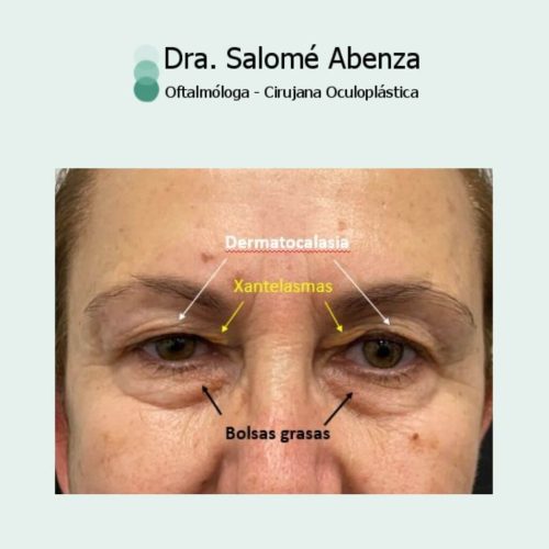 Blefaroplastia superior con extirpación de xantelasmas (acúmulos amarillentos de grasa) y blefaroplastia inferior transconjuntival (por dentro del párpado sin cicatrices) asociado a cantopexia bilateral para tensado palpebral. 