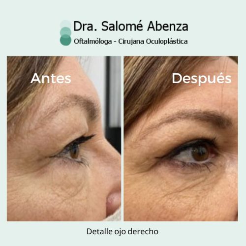 Cirugía de blefaroplastia superior e inferior transconjuntival con cantopexia bilateral a los 6 meses de la intervención. Detalles de ojo derecho. Cirugía de blefaroplastia superior e inferior transconjuntival con cantopexia bilateral a los 6 meses de la intervención. Detalles de ojo derecho.
