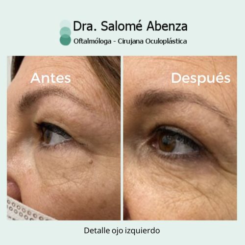 Cirugía de blefaroplastia superior e inferior transconjuntival con cantopexia bilateral a los 6 meses de la intervención. Detalles de ojo izquierdo. Cirugía de blefaroplastia superior e inferior transconjuntival con cantopexia bilateral a los 6 meses de la intervención. Detalles de ojo izquierdo.
