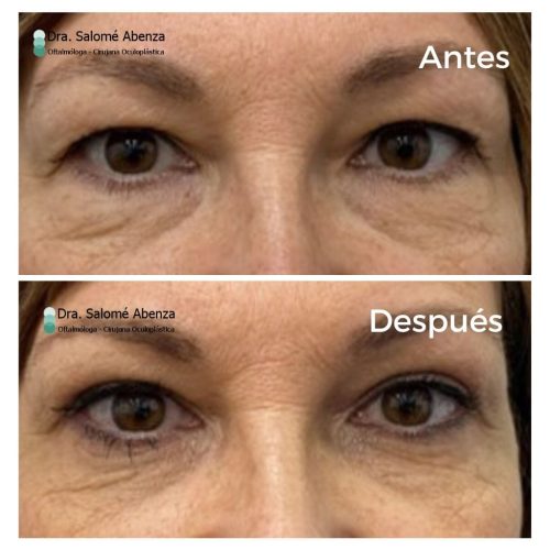 Cirugía de blefaroplastia superior e inferior transconjuntival con cantopexia bilateral a los 6 meses de la intervención. Detalles con mirada al frente.