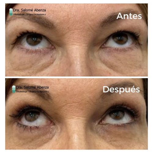 Cirugía de blefaroplastia superior e inferior transconjuntival con cantopexia bilateral a los 6 meses de la intervención.  Detalles con mirada hacia arriba.