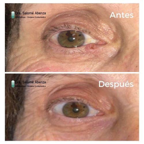 Carcinoma basocelular en canto interno derecho con reconstrucción de vía lagrimal, antes y 1 año después tras la cirugía. Carcinoma basocelular en canto interno derecho con reconstrucción de vía lagrimal, antes y 1 año después tras la cirugía.