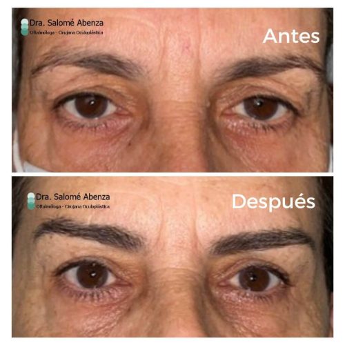 Cirugía de cejaplastia temporal y blefaroplastia superior a los 7 meses de la cirugía. Obsérvense las mínimas cicatrices de las cejas y el parpado superior.  