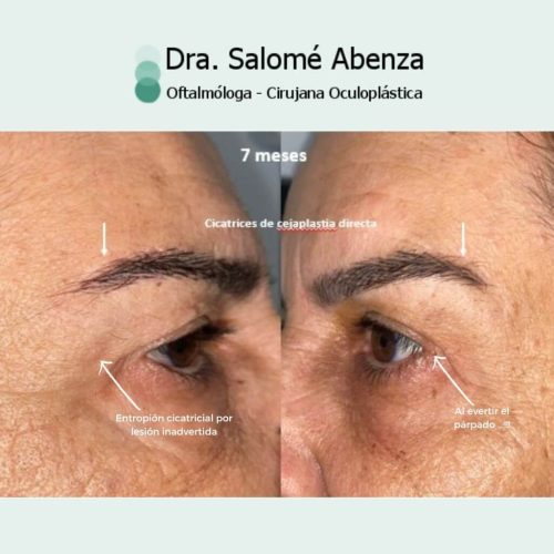 Cirugía de cejaplastia temporal y blefaroplastia superior a los 7 meses de la cirugía. Detalle de las cicatrices en las cejas.