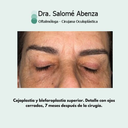 Cirugía de cejaplastia temporal y blefaroplastia superior a los 7 meses de la cirugía. Detalle del resultado tras la intervención.  