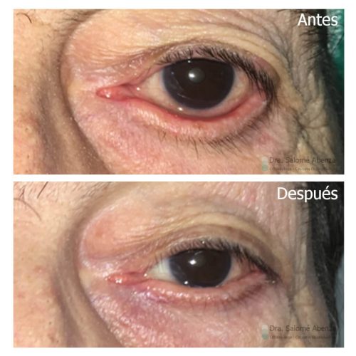 Ectropion del párpado inferior izquierdo reparado mediante técnica de cantoplastia o tira tarsal lateral. Ectropion del párpado inferior izquierdo reparado mediante técnica de cantoplastia o tira tarsal lateral.