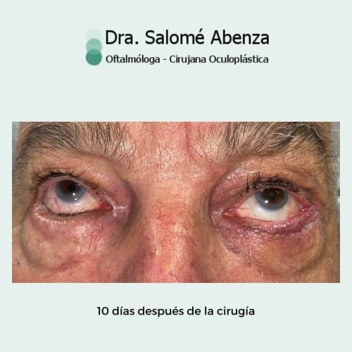 Entropion senil bilateral