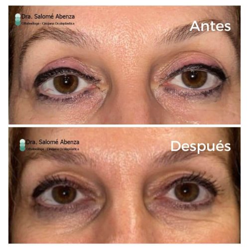 Cirugía de reinserción de aponeurosis vía anterior para corregir su ptosis palpebral aponeurótica y blefaroplastia superior bilateral a los 6 meses de la intervención.