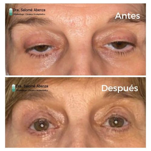 Paciente con Distrofia oculofaríngea (DOF) con ptosis palpebral severa Paciente con Distrofia oculofaríngea (DOF) con ptosis palpebral severa