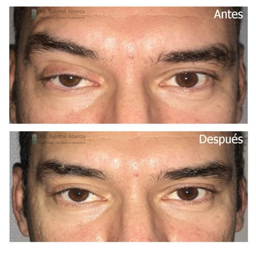 Ptosis miogénica congénita derecha tratada mediante resección del músculo elevador del párpado vía anterior. Nótese como la elevación compensadora de la ceja derecha se corrige tras la cirugía palpebral.