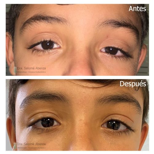 Ptosis miogénica congénita izquierda tratada mediante resección del músculo elevador del párpado vía anterior.
